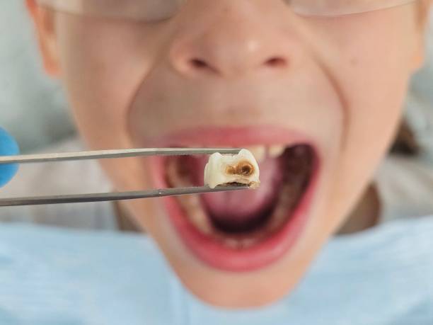 Best Emergency Tooth Extraction in Blountstown, FL